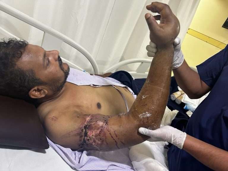हस्तप्रत्यारोपणाची तब्बल सहा तास चाललेली अतिशय गुंतागुंतीची शस्त्रक्रिया यशस्वीपणे केली पूर्ण- सह्याद्रि हॉस्पिटल्सच्या डॉक्टरांना यश 